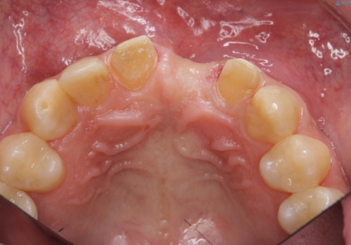 前歯にボールが当たってダメになってしまった とりあえず横の歯に接着剤でつけてしのいでいたのを、しっかりブリッジで治療の治療中
