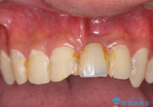 前歯にボールが当たってダメになってしまった とりあえず横の歯に接着剤でつけてしのいでいたのを、しっかりブリッジで治療