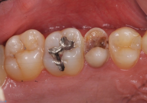 放置した虫歯　歯ぐきの中まで虫歯でも、しっかり健康的な部分を引っ張り出して、きちんと処置します。の治療前