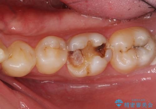 放置した虫歯の治療　親知らずの手前が虫歯