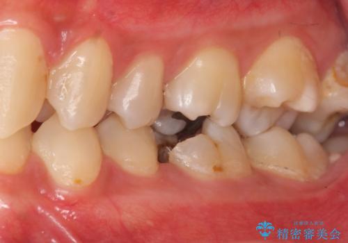 放置した虫歯の治療 親知らずの手前が虫歯の治療前