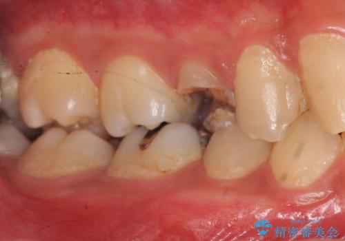 放置した虫歯　歯ぐきの中まで虫歯でも、しっかり健康的な部分を引っ張り出して、きちんと処置します。の治療前