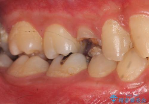 放置した虫歯　歯ぐきの中まで虫歯でも、しっかり健康的な部分を引っ張り出して、きちんと処置します。の症例 治療前
