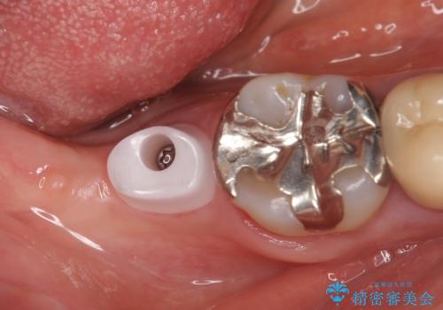 インプラント 抜歯になった奥歯の治療の治療中