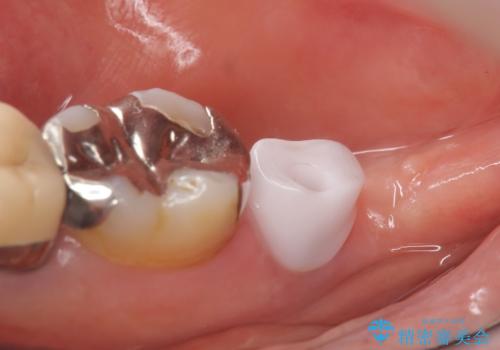 インプラント 抜歯になった奥歯の治療の治療中