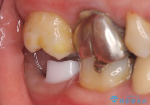 インプラント 抜歯になった奥歯の治療の治療中