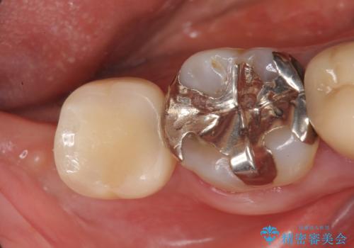 インプラント 抜歯になった奥歯の治療の症例 治療後