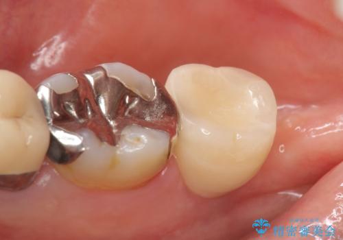 インプラント 抜歯になった奥歯の治療の治療後