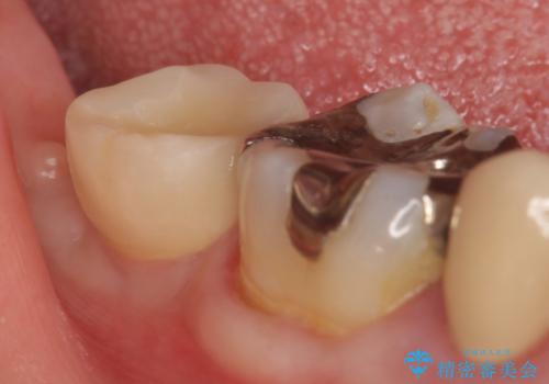 インプラント　抜歯になった奥歯の治療の治療後