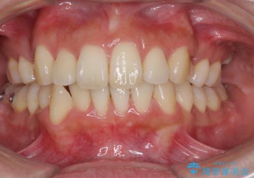 裏側装置で出っ歯の矯正治療の治療中