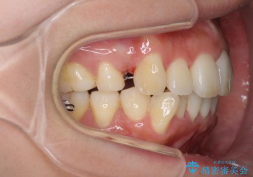 裏側装置で出っ歯の矯正治療の治療中