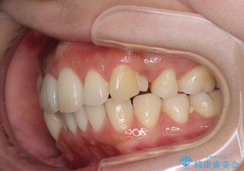 裏側装置で出っ歯の矯正治療の治療中