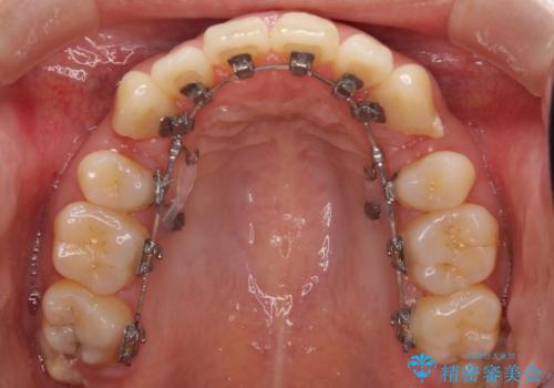 裏側装置で出っ歯の矯正治療の治療中