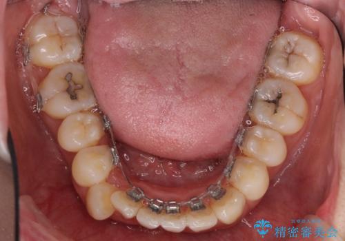 裏側装置で出っ歯の矯正治療の治療中