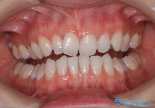 PMTCでコーヒーの着色取りの治療前