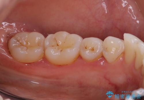 PMTCでコーヒーの着色取りの治療前