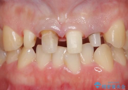 オールセラミッククラウン(スペシャル) 前歯を綺麗にの治療中