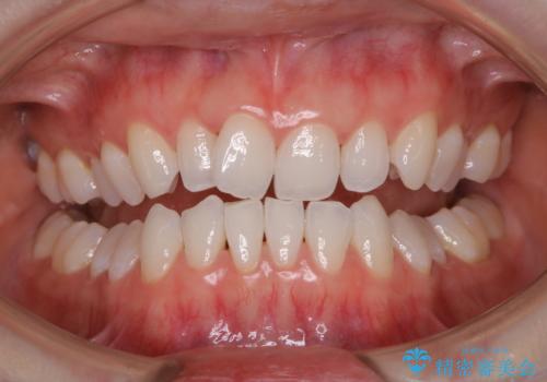 PMTCでコーヒーの着色取りの治療後