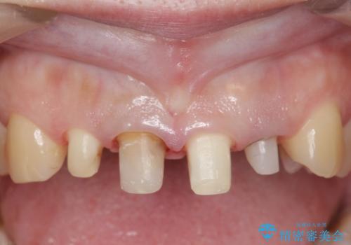 オールセラミッククラウン(スペシャル) 前歯を綺麗にの治療中