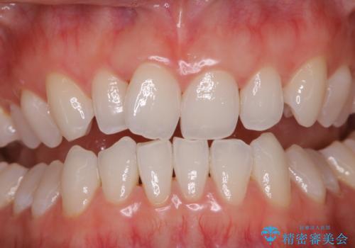 PMTCでコーヒーの着色取りの治療後