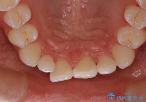 PMTCでコーヒーの着色取りの症例 治療後