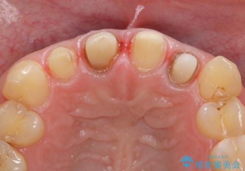 オールセラミッククラウン(スペシャル) 前歯を綺麗にの治療中