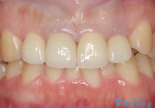 オールセラミッククラウン(スペシャル) 前歯を綺麗にの治療後