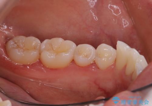 PMTCでコーヒーの着色取りの治療後