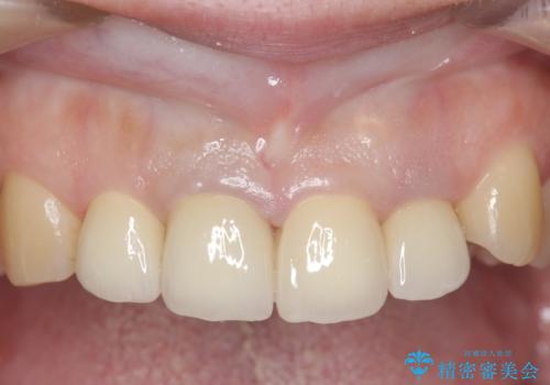 オールセラミッククラウン(スペシャル) 前歯を綺麗にの治療後