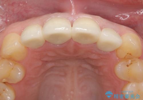 オールセラミッククラウン(スペシャル) 前歯を綺麗にの治療後