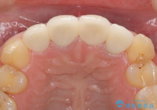 オールセラミッククラウン(スペシャル) 前歯を綺麗にの治療後