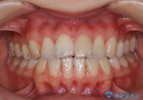 1年ぶりにPMTCで歯の着色落としの治療前