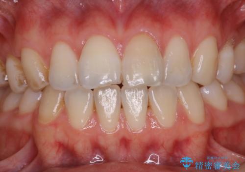 1年ぶりにPMTCで歯の着色落としの治療前