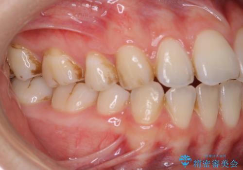 1年ぶりにPMTCで歯の着色落としの治療前