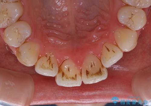 1年ぶりにPMTCで歯の着色落としの治療前