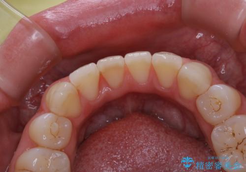 1年ぶりにPMTCで歯の着色落としの治療前