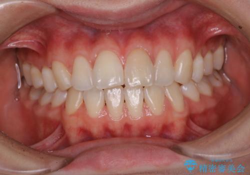 1年ぶりにPMTCで歯の着色落としの治療後