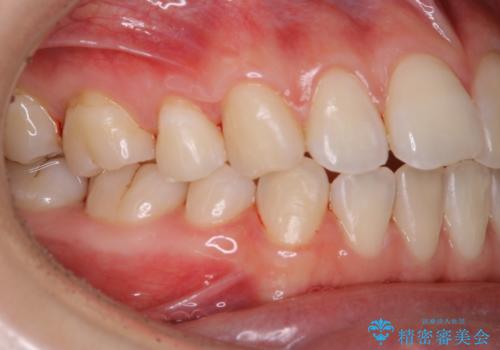 1年ぶりにPMTCで歯の着色落としの治療後