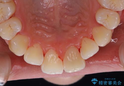 1年ぶりにPMTCで歯の着色落としの治療後