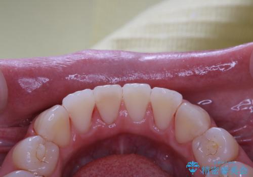 1年ぶりにPMTCで歯の着色落としの治療後