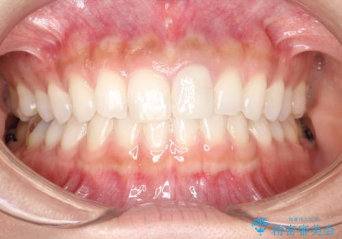 前歯のかぶせ物の色があっていない　オールセラミック治療の治療後