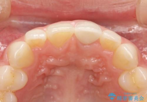前歯のかぶせ物の色があっていない オールセラミック治療の治療後