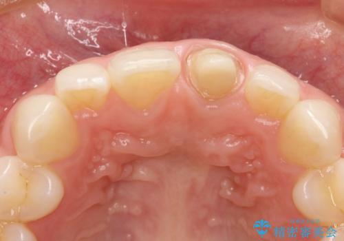 前歯のかぶせ物の色があっていない オールセラミック治療の治療中