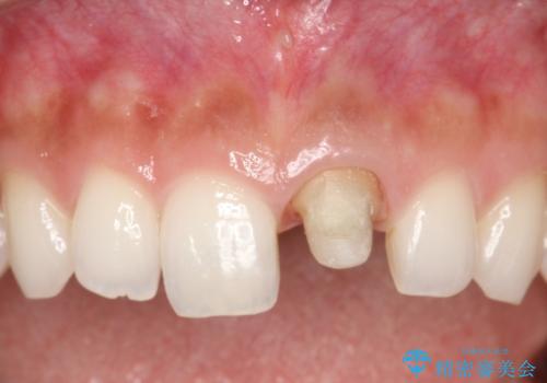 前歯のかぶせ物の色があっていない　オールセラミック治療の治療中