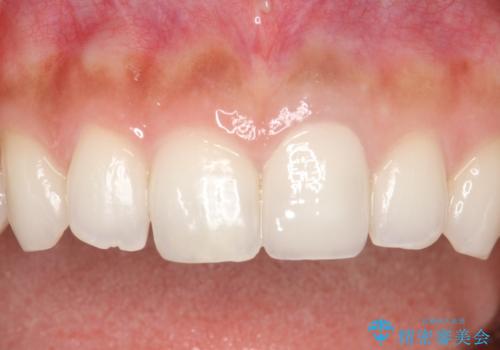 前歯のかぶせ物の色があっていない オールセラミック治療の治療後