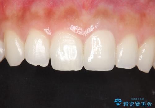 前歯のかぶせ物の色があっていない　オールセラミック治療の治療後