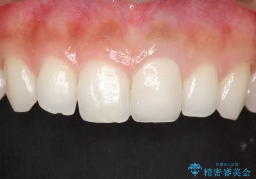 前歯のかぶせ物の色があっていない オールセラミック治療