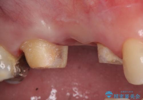 オールセラミッククラウン　歯根破折→抜歯→ブリッジの治療中