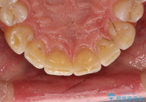 歯石除去 PMTCの治療前