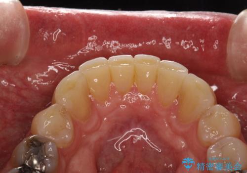 歯石除去 PMTCの治療前